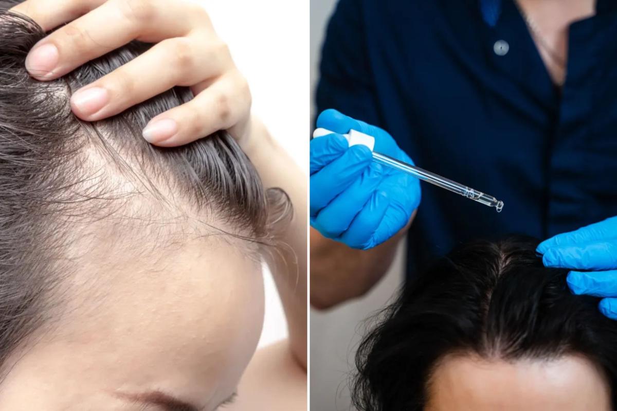 Triple threat fights hair loss better than finasteride and minoxidil