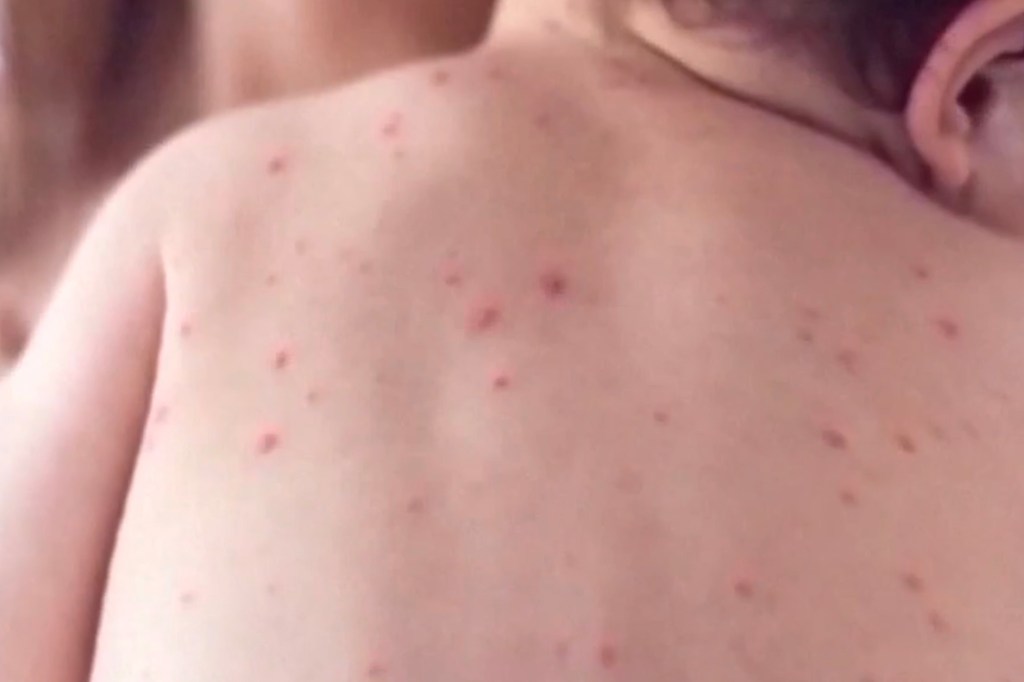 Close-up of a person's upper back and shoulder covered in a measles rash.