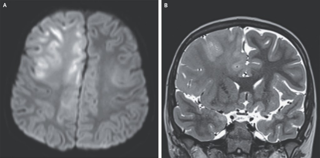 Collage of an axial diffusion-weighted MR image of the brain showing cortical signal abnormalities and a coronal T2-weighted MR image of the brain showing cerebral atrophy and signal abnormalities.
