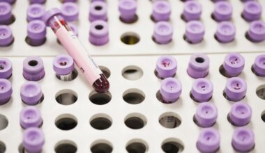 New guidelines offer updated approach for managing high cholesterol : NPR