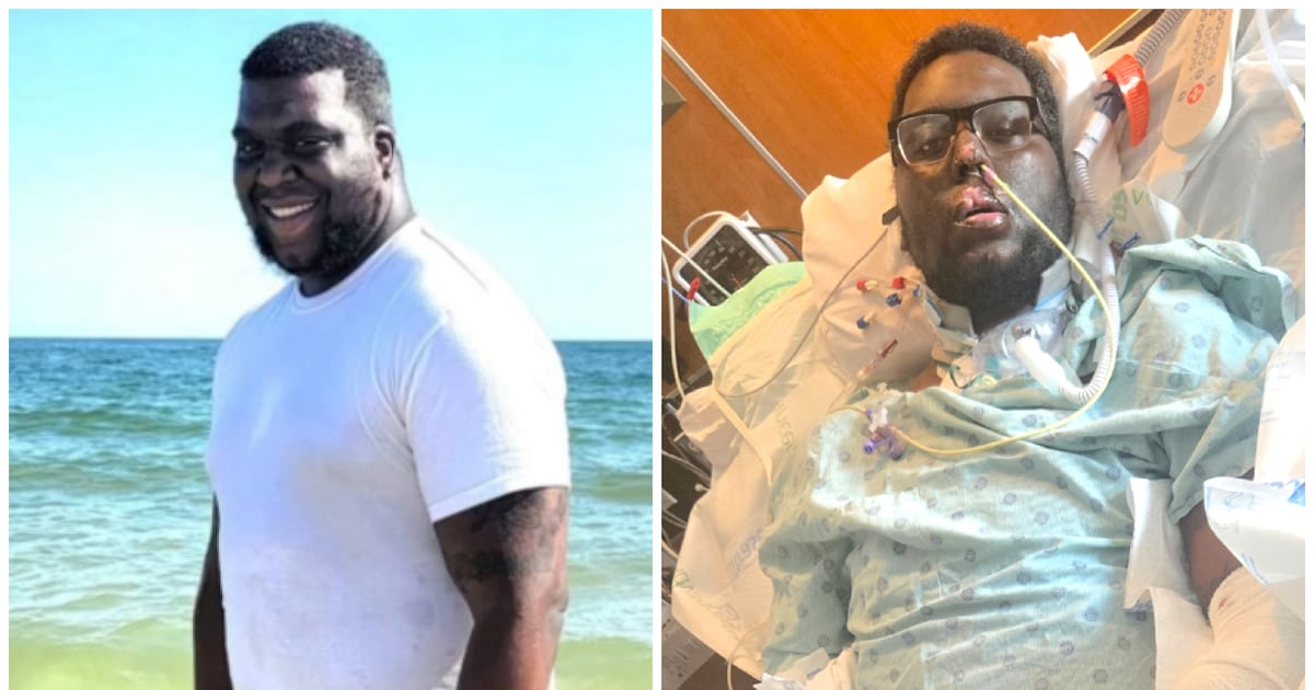 Man Endures Sepsis and Triple Amputation After Routine Dental Exam