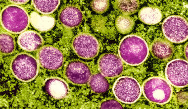 California officials worry as weekly average of rare viral cases rise