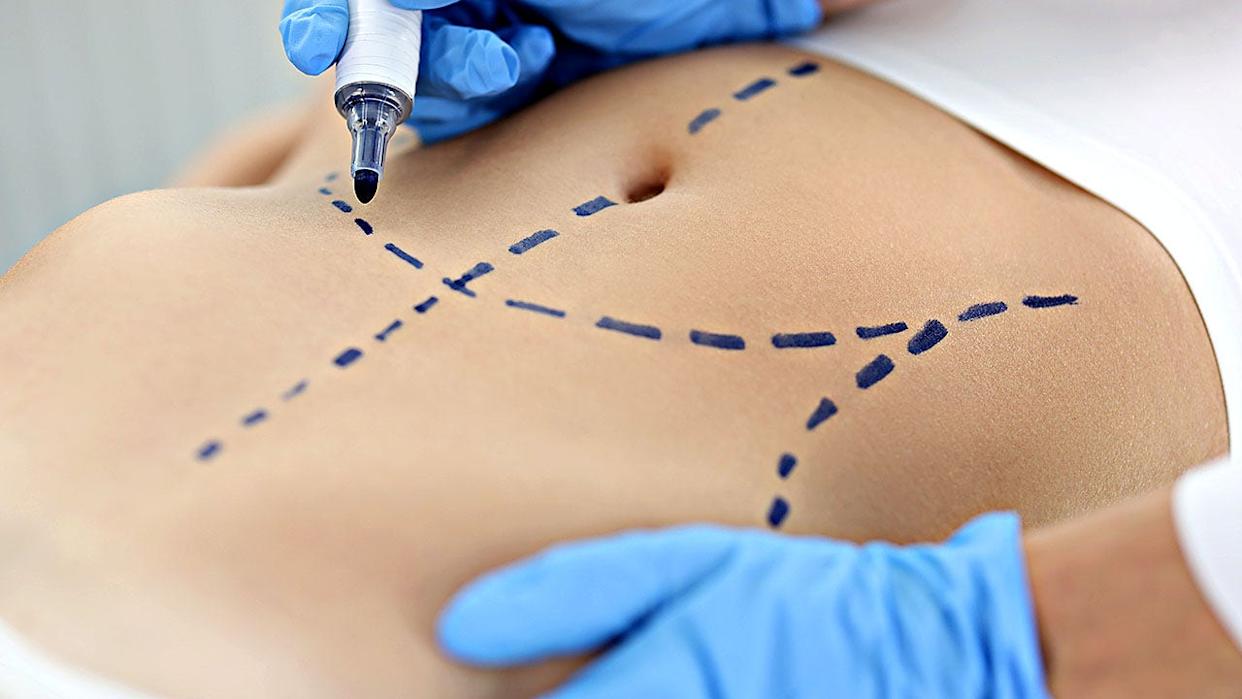 Doctor plastic surgeon drawing preoperative markings on patient's abdomen skin closeup