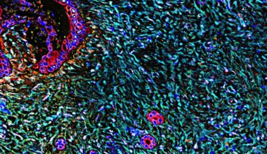 Expert analyzes potential new pancreatic cancer breakthrough