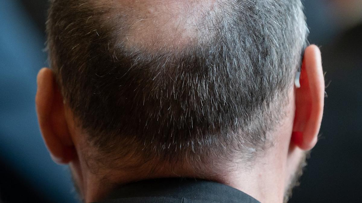 Veradermics hair loss pill passes late-stage clinical trial