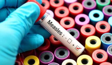 State reports measles case, warns of exposure in Kenner | Health care/Hospitals