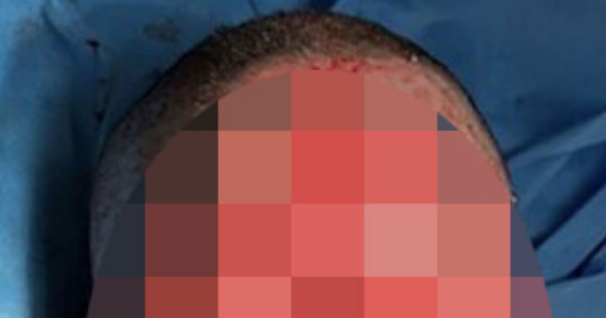 Panic as drug used by millions in the UK leaves woman with blisters and scarring on face | UK | News