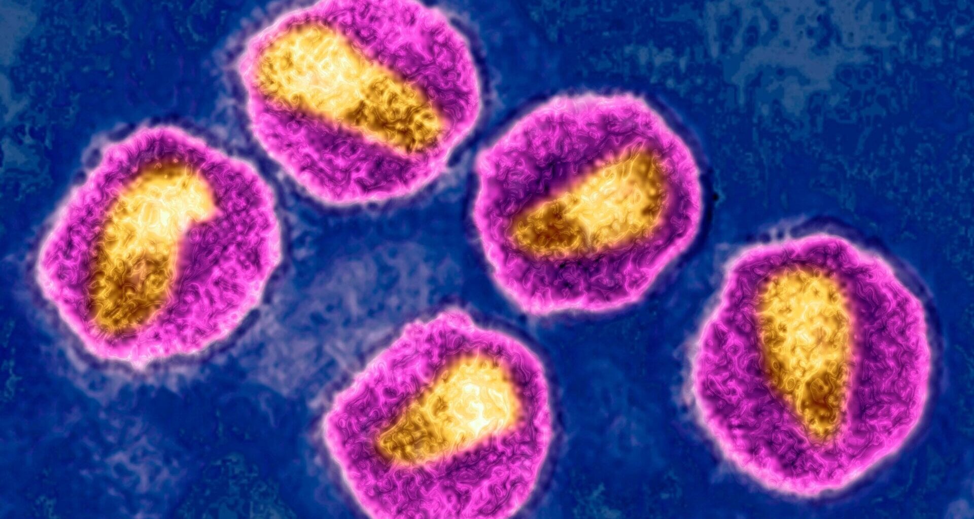 An image of the HIV virus taken with transmission electron microscopy.