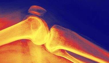 How Long Does It Take to Increase Bone Density?