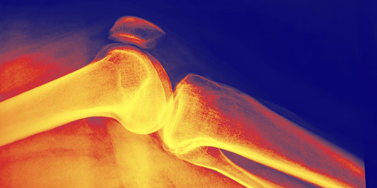 How Long Does It Take to Increase Bone Density?