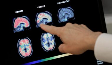 Can a simple nasal spray soothe the aging brain? - Baltimore Sun