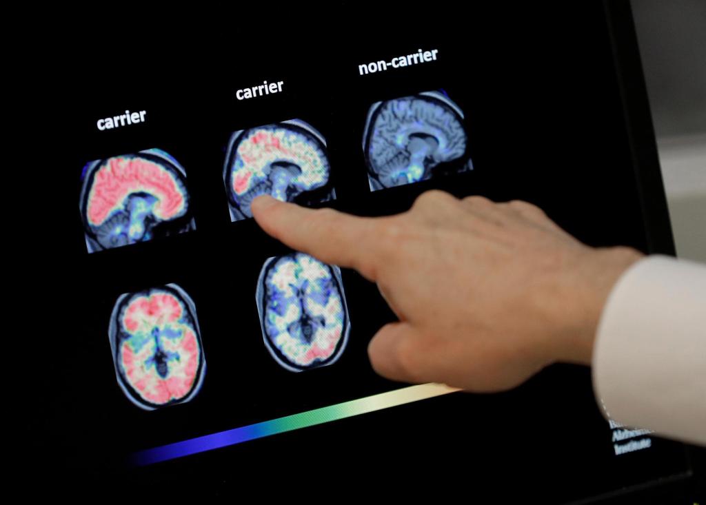 Can a simple nasal spray soothe the aging brain? - Baltimore Sun