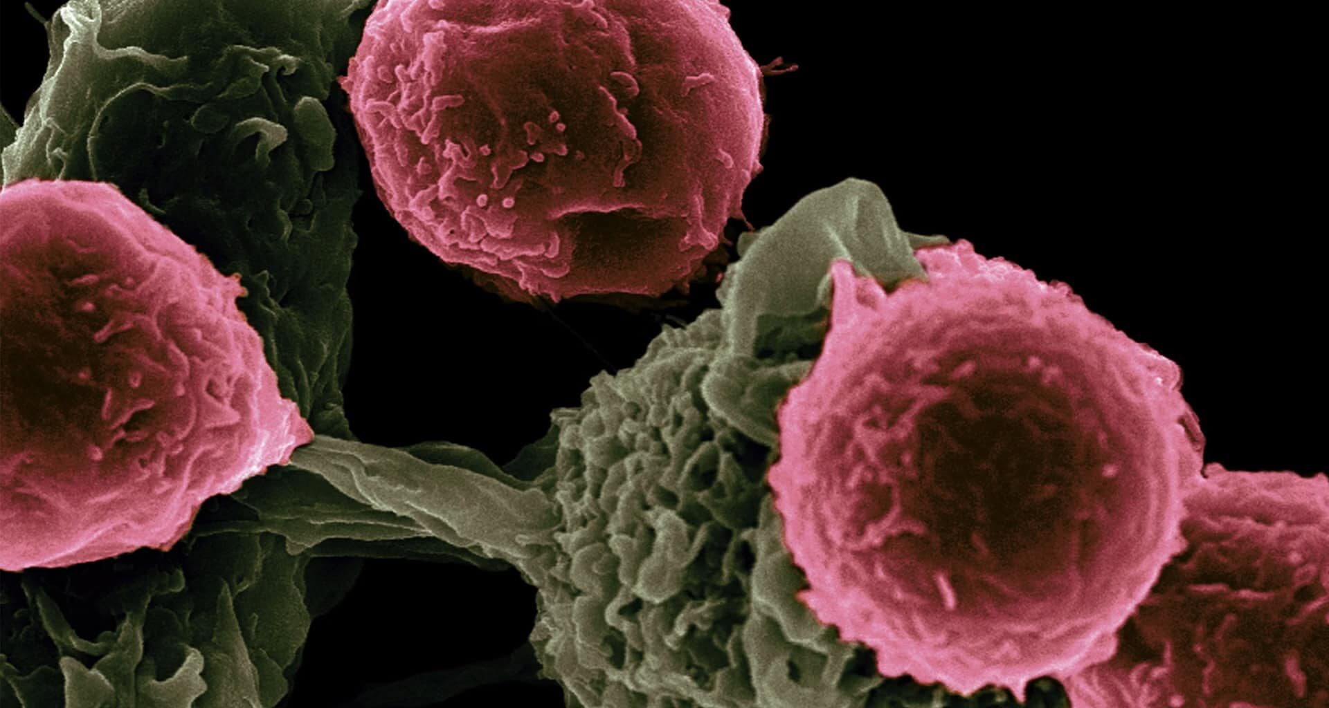 Revolutionary Therapy Cured Three "Incurable" Autoimmune Diseases in a Patient