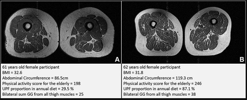 Representative axial T1-weighted spin-echo thigh MRI scans in (A) a 61-year-old female participant and (B) a 62-year-old female participant. Both participants were of similar age and body mass index (BMI, calculated as weight in kilograms divided by height in meters squared). Both had Physical Activity Scale for the Elderly scores above the mean score in the study. According to the World Health Organization definition, the participant in B qualified as having abdominal obesity (abdominal circumference ≥ 88 cm). Abdominal circumference is a measure of central obesity that captures fat distribution and serves as an indicator of cardiometabolic health. Compared with the participant in A, the participant in B had a higher proportion of ultra-processed food (UPF) in their diet (87.1% vs 29.5%) and exhibited fattier thigh muscles bilaterally, with Goutallier grade (GG) for all thigh muscles summing to 25 for the participant in A and 38 for the participant in B. Image: Credit Radiological Society of North America (RSNA)