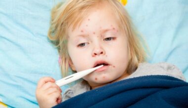 Study highlights the fragility of measles elimination in the United States