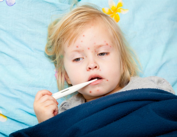 Study highlights the fragility of measles elimination in the United States