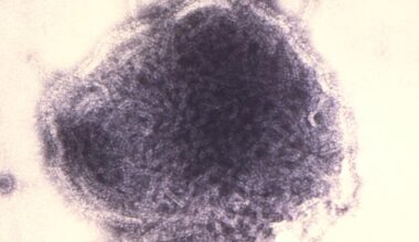 US nears 1,700 measles cases, with 73 new infections in Utah