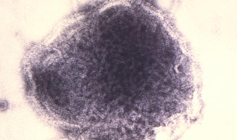 US nears 1,700 measles cases, with 73 new infections in Utah