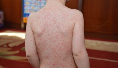 That Teenage Bout of Mono May Have a Troubling Second Act