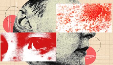 You Should Be More Freaked Out by Shingles
