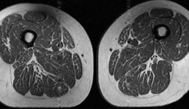 Ultraprocessed foods are turning human thighs into well-marbled steaks