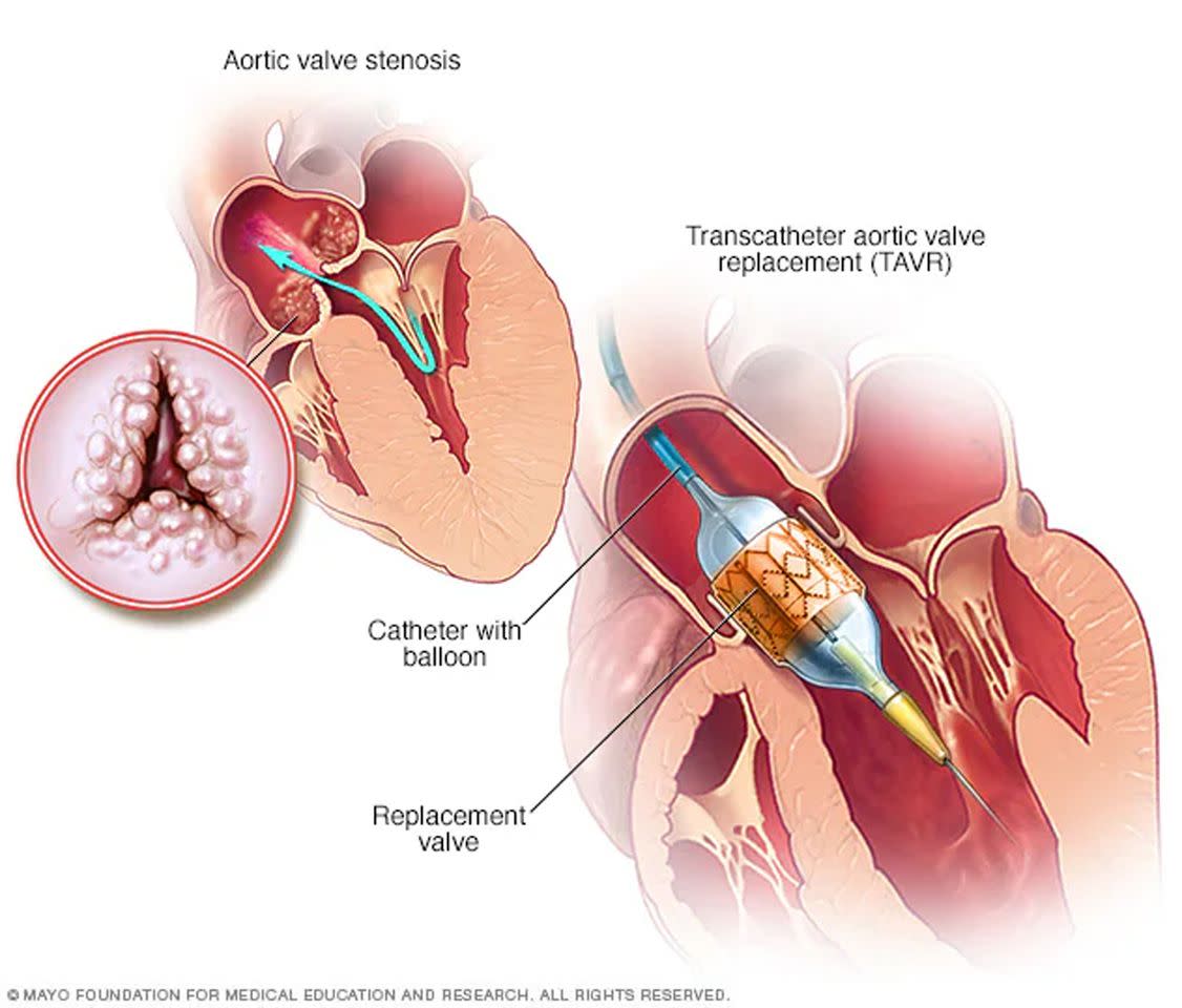 TAVR procedureCredit: Mayo Foundation for Medical Education and Research