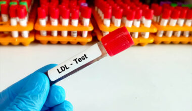 Doctors updated the LDL cholesterol target for optimal heart health