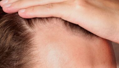 'Rogaine' in a Pill? Oral Minoxidil Aces Major Hair Loss Trial