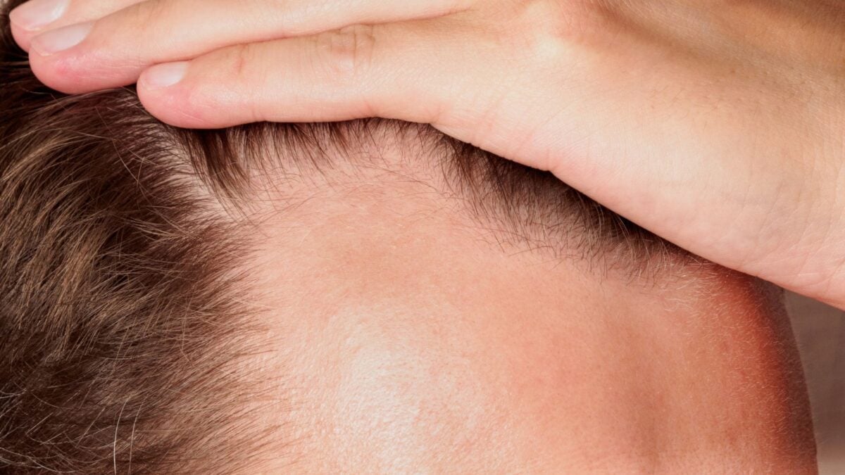 'Rogaine' in a Pill? Oral Minoxidil Aces Major Hair Loss Trial