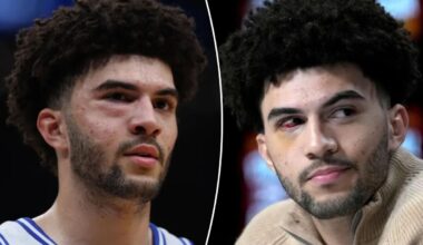 Cameron Boozer suffered multiple facial fractures in loss to UConn