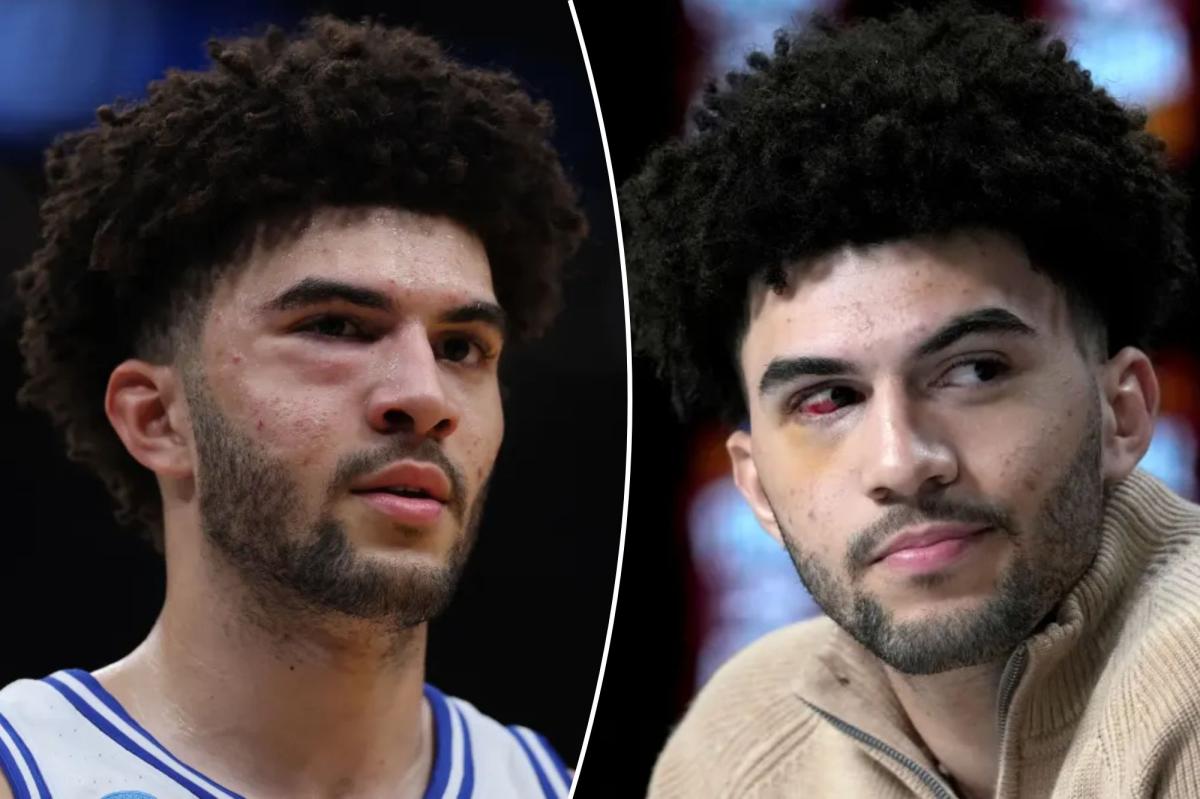 Cameron Boozer suffered multiple facial fractures in loss to UConn