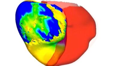 Virtual replicas of patients' hearts help doctors tackle irregular heartbeat