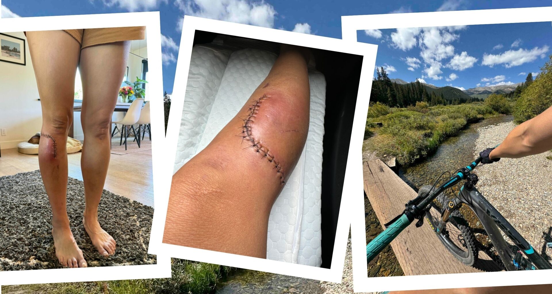 collage of bike injury and arterial gash