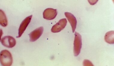 Sickle cell disease patients at Long Island hospitals had highest risk of dying, study finds