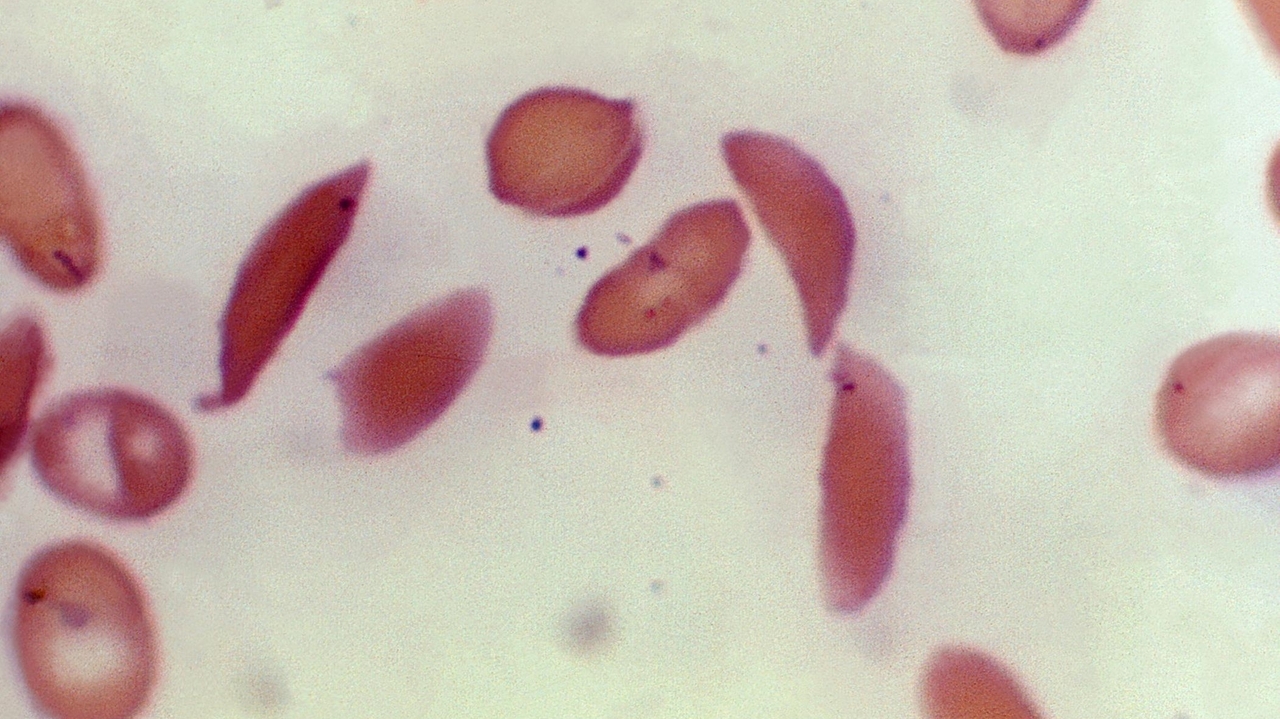 Sickle cell disease patients at Long Island hospitals had highest risk of dying, study finds