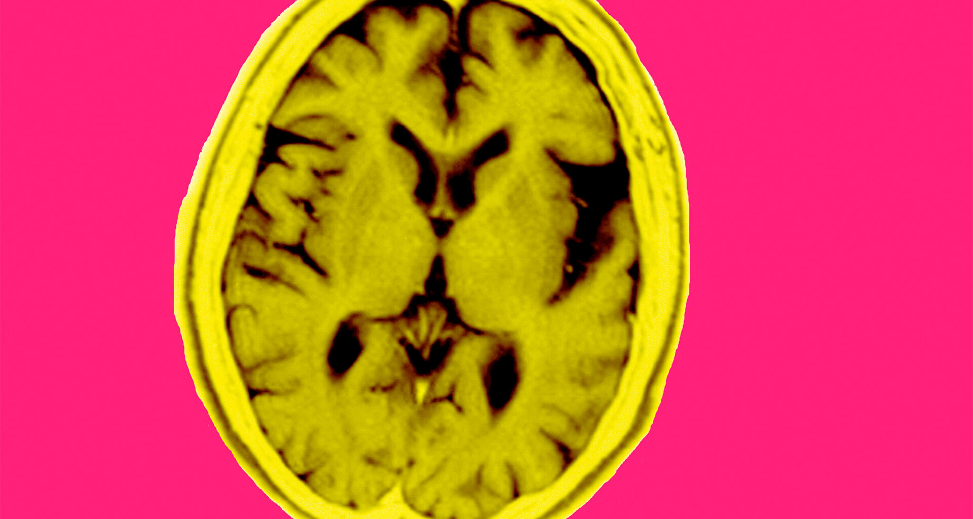 UCSF study shows blood test may catch early cognitive trouble