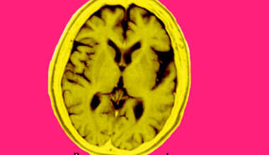 UCSF study shows blood test may catch early cognitive trouble