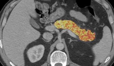 AI finds signs of pancreatic cancer before tumors develop