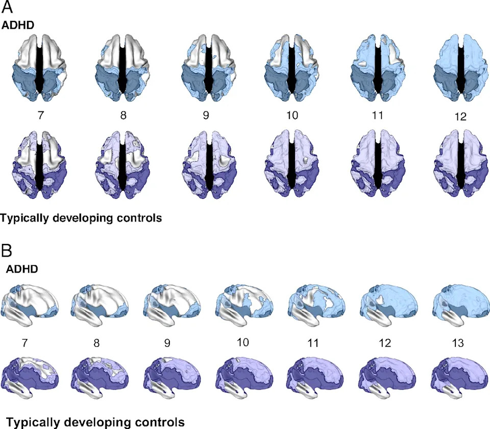 A series of graphics of a brain with different purple and blue areas shaded in.