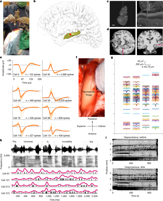 Plasticity and language in the anaesthetized human hippocampus