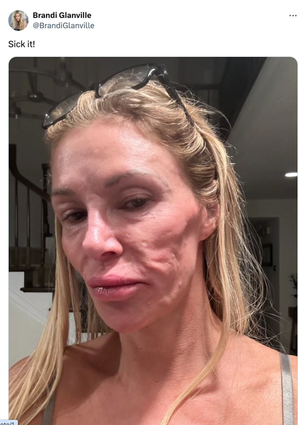 Glanville has detailed her health struggles on social media for years (X/@BrandiGlanville)