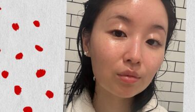 What Is an Accutane Nose Job?