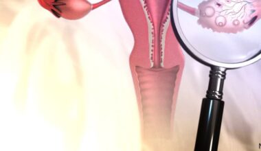 PCOS gets a new name to better reflect the condition