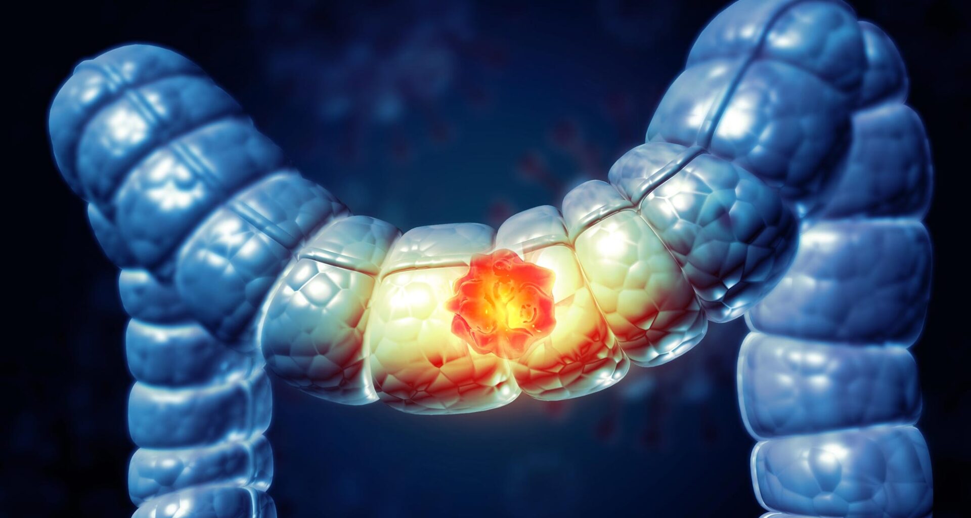 Colon Cancer Large Intestine