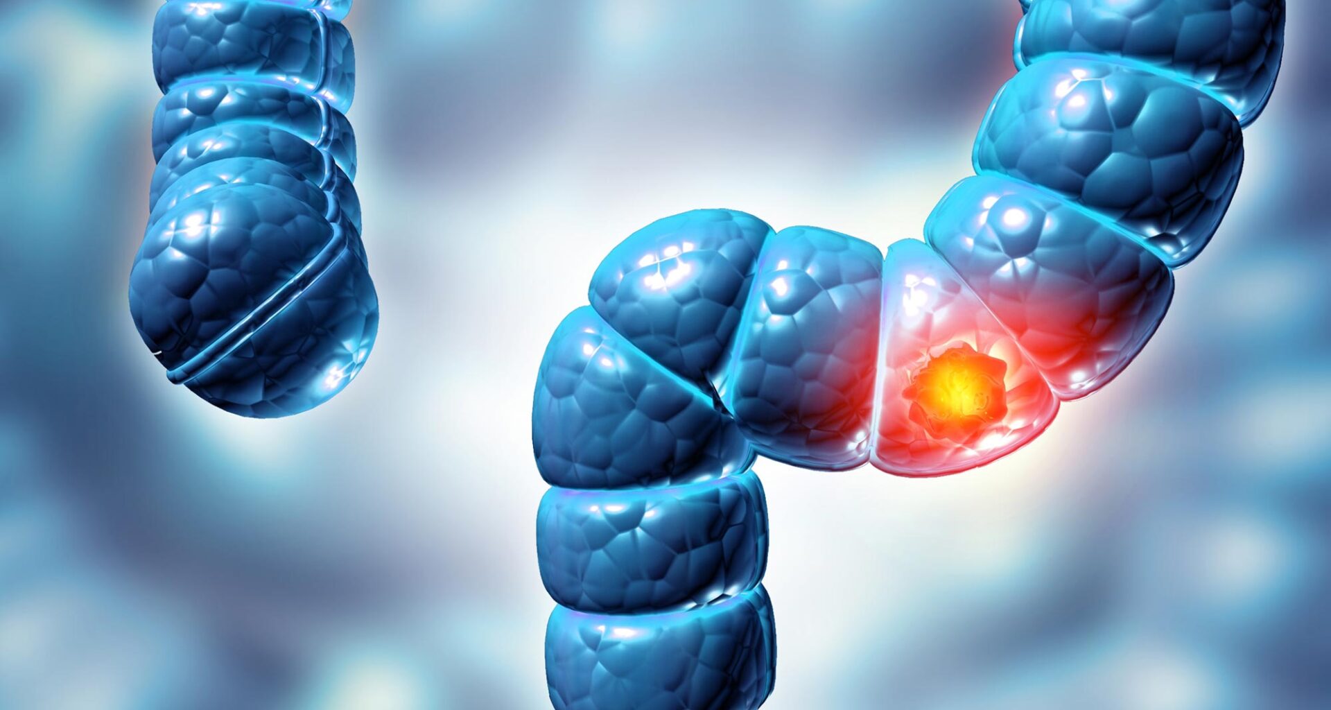 Colon Colorectal Cancer