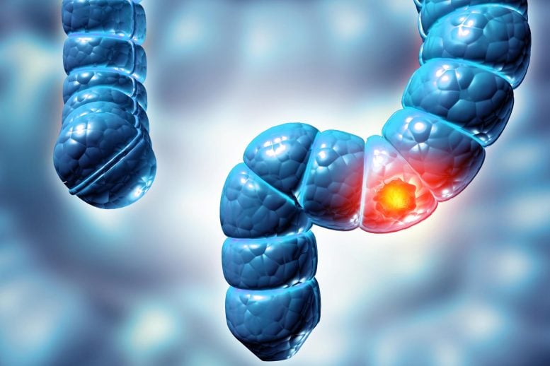 Colon Colorectal Cancer