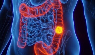 Program expands colon cancer screening - UW Medicine