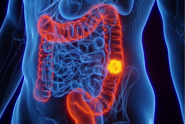 Program expands colon cancer screening - UW Medicine