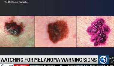Melanoma Monday highlights warning signs of deadliest skin cancer