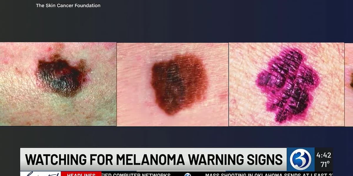 Melanoma Monday highlights warning signs of deadliest skin cancer